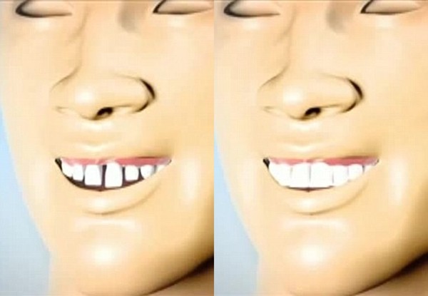 Chi tiền tỷ sửa răng, R&ocirc; &ldquo;vẩu&rdquo; đ&atilde; kh&ocirc;ng c&ograve;n &ldquo;vẩu&rdquo; nữa? 4