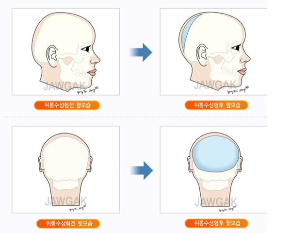 Kỳ quặc sở thích phẫu thuật thẩm mỹ làm cho đầu... tròn hơn 2