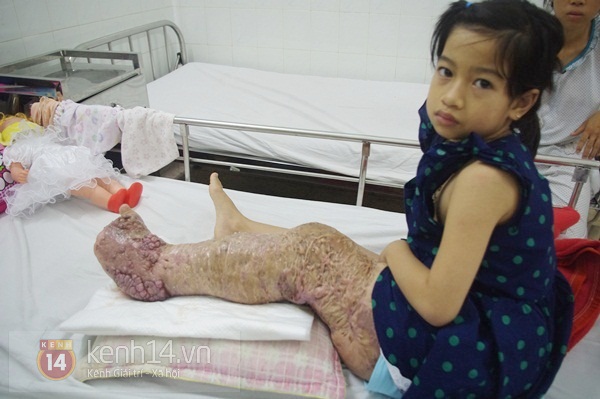 Đời nghiệt ngã của cô bé 10 tuổi mắc bệnh “chân voi" 1