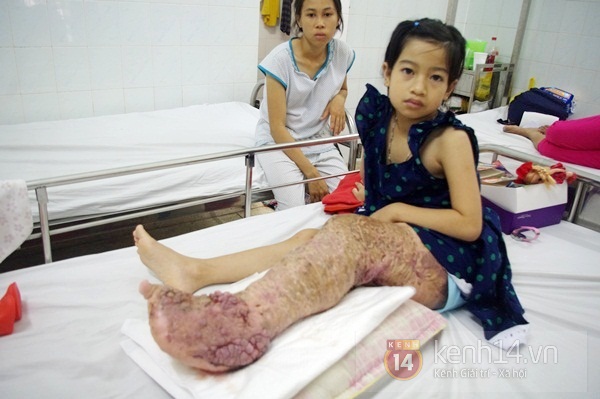 Đời nghiệt ngã của cô bé 10 tuổi mắc bệnh “chân voi" 2