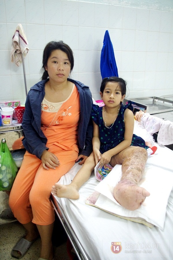 Đời nghiệt ngã của cô bé 10 tuổi mắc bệnh “chân voi" 9