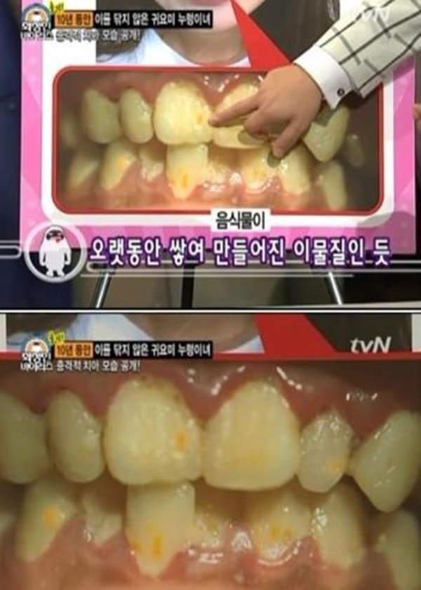 H&agrave;n Quốc: Kỳ lạ c&ocirc; n&agrave;ng 10 năm liền kh&ocirc;ng đ&aacute;nh răng 5