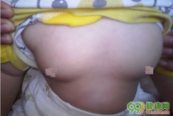 Trung Quốc: Bé gái hơn 1 tuổi ngực to như... thiếu nữ 1