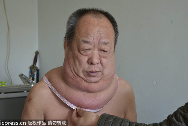 Trung Quốc: Người đàn ông với chiếc cổ "phát phì" kì lạ 1
