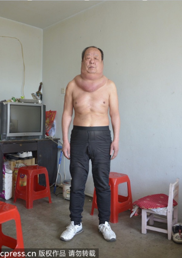 Trung Quốc: Người đàn ông với chiếc cổ "phát phì" kì lạ 2