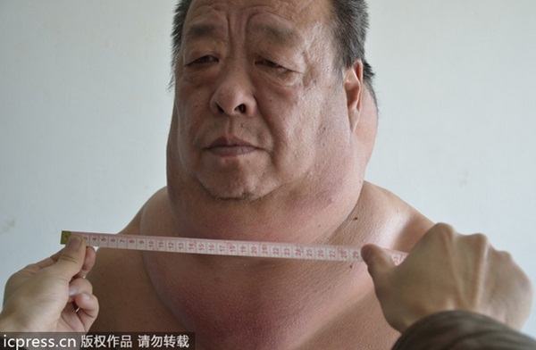 Trung Quốc: Người đàn ông với chiếc cổ "phát phì" kì lạ 4