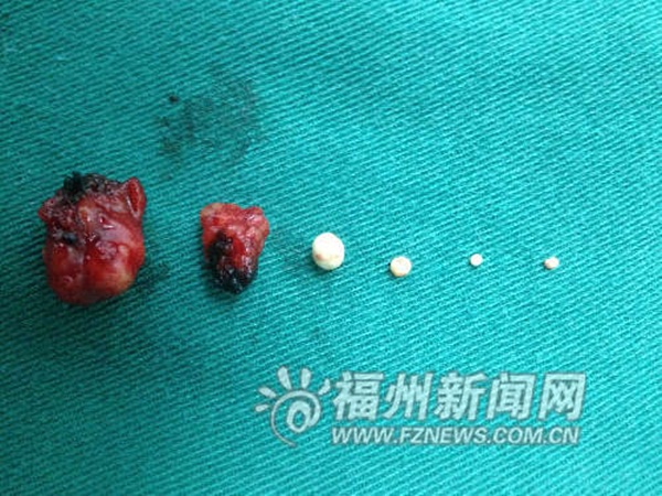 Trung Quốc: Mọc 4 vi&ecirc;n &ldquo;tr&acirc;n ch&acirc;u&rdquo; ở bọng mắt 1