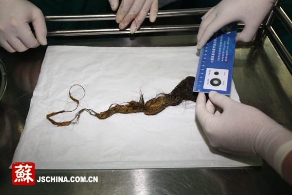 Trung Quốc: Choáng với bé gái có búi tóc dài 23cm trong bụng 2