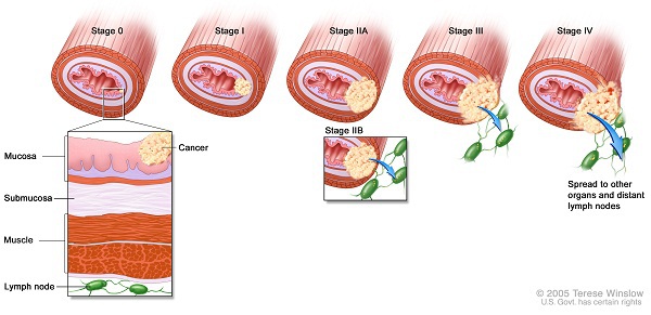 Cận cảnh sự t&agrave;n ph&aacute; của ung thư v&uacute; tới bầu ngực 3