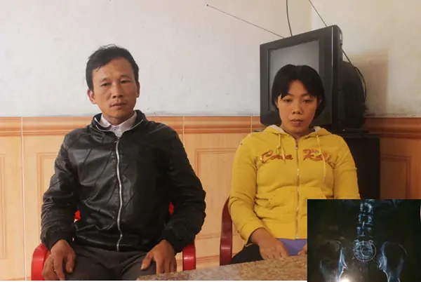 Giãi bày của bác sỹ để quên kim trong bụng bệnh nhân 3