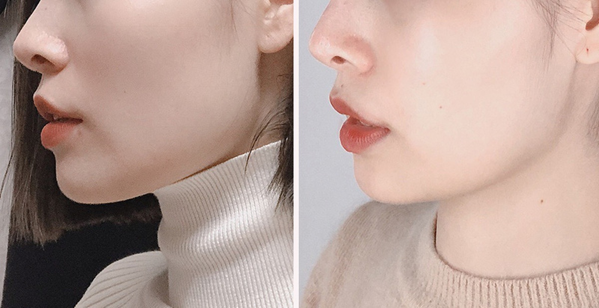 Allergan, Nabota Hay Hugel? Giải Mã 3 Thương Hiệu Botox Chín