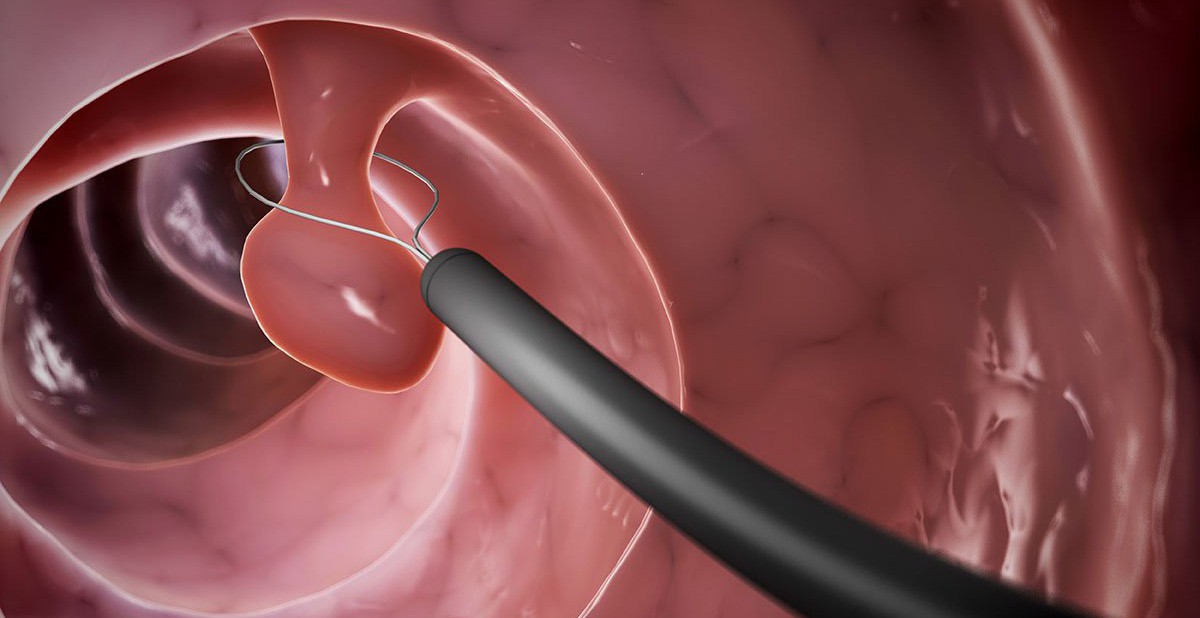 Polyp là gì? 4 bộ phận trong cơ thể nếu có polyp thì nguy cơ mắc bệnh ...