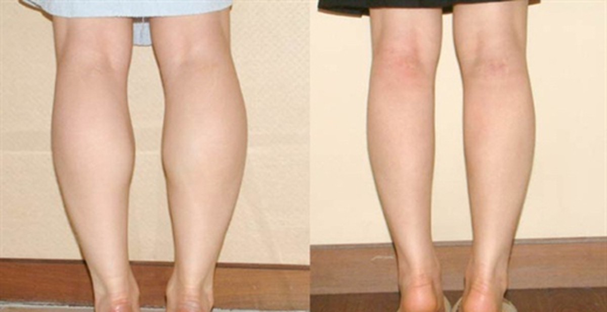 5 thói quen hàng ngày giúp bạn thoát khỏi đôi chân "cột đình", làm đúng và  đủ còn giảm hẳn 3cm vòng đùi
