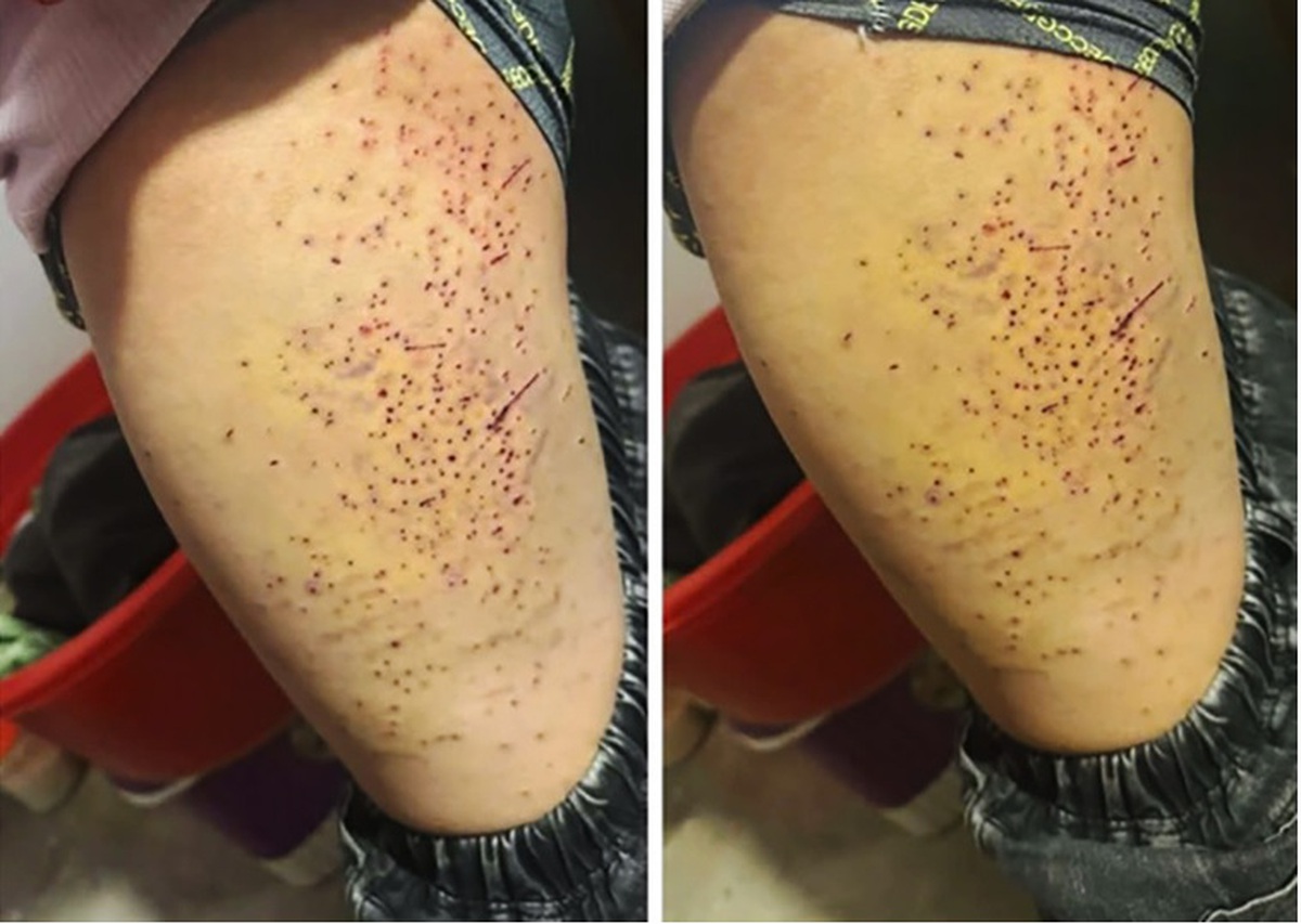 Nữ sinh lớp 7 dùng bút bi đâm hơn 20 lần lần vào đùi bạn học: Đây là nguyên nhân