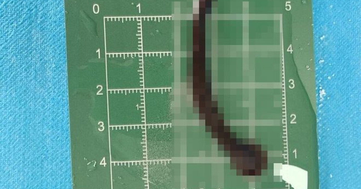 Bé trai 8 tuổi ho ra máu suốt 10 ngày, bác sĩ gắp được "thủ phạm" hút máu dài 8cm đang ngo ngoe bò trườn
