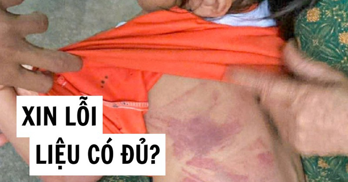 Tôi bàng hoàng khi xem bức ảnh bé gái Tiểu học bị bạn nam cùng lớp đánh bầm lưng: Hỏi thật, một lời xin lỗi liệu có đủ?