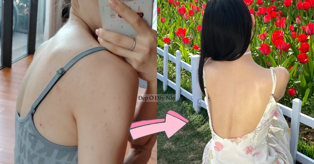 Cô nàng này áp dụng đúng 3 bước để làm sạch mụn lưng, tha hồ diện đồ hở mùa hè
