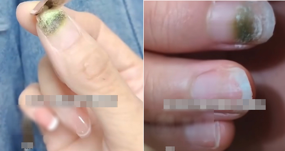 Bác sĩ cảnh báo phụ nữ bị mốc móng sau khi làm nails