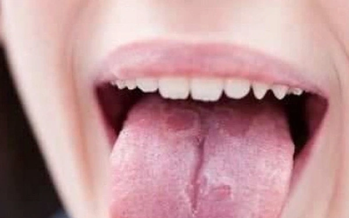 Nấm miệng họng do Candida: Cảnh báo từ những mảng trắng bất thường