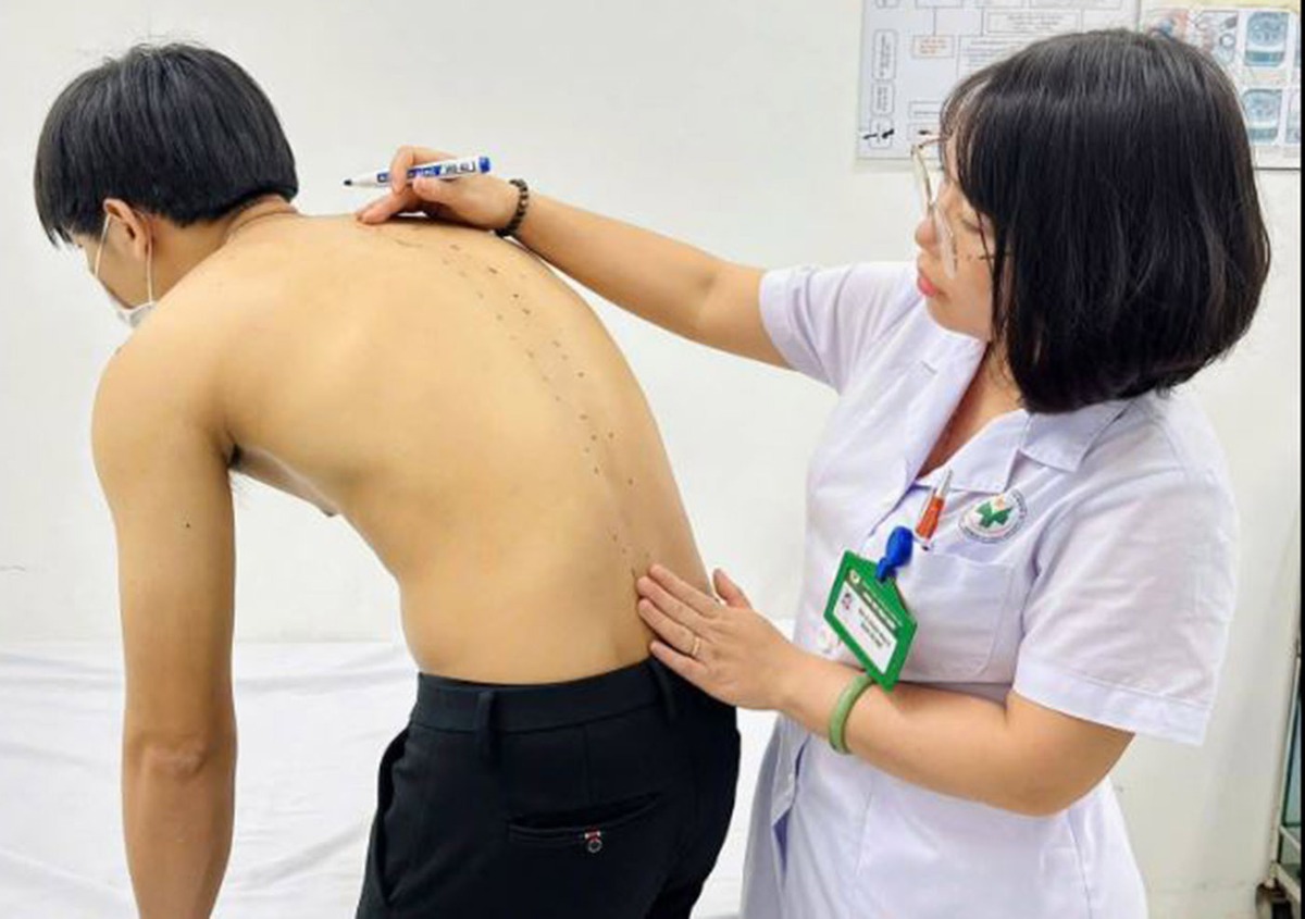 Tưởng đau lưng do tập gym, chàng trai 20 tuổi mắc viêm cột sống dính khớp