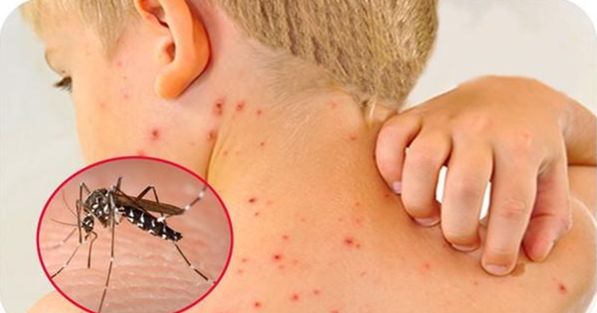 Dịch sốt xuất huyết tăng cao, chuyên gia cảnh báo biến chứng nặng của bệnh