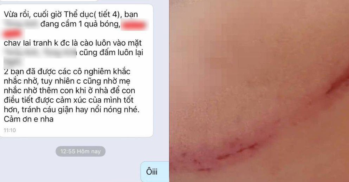 Nhìn 2 vết xước trên mặt học sinh Hà Nội này mà xót: Câu chuyện phía sau thổi bùng tranh luận