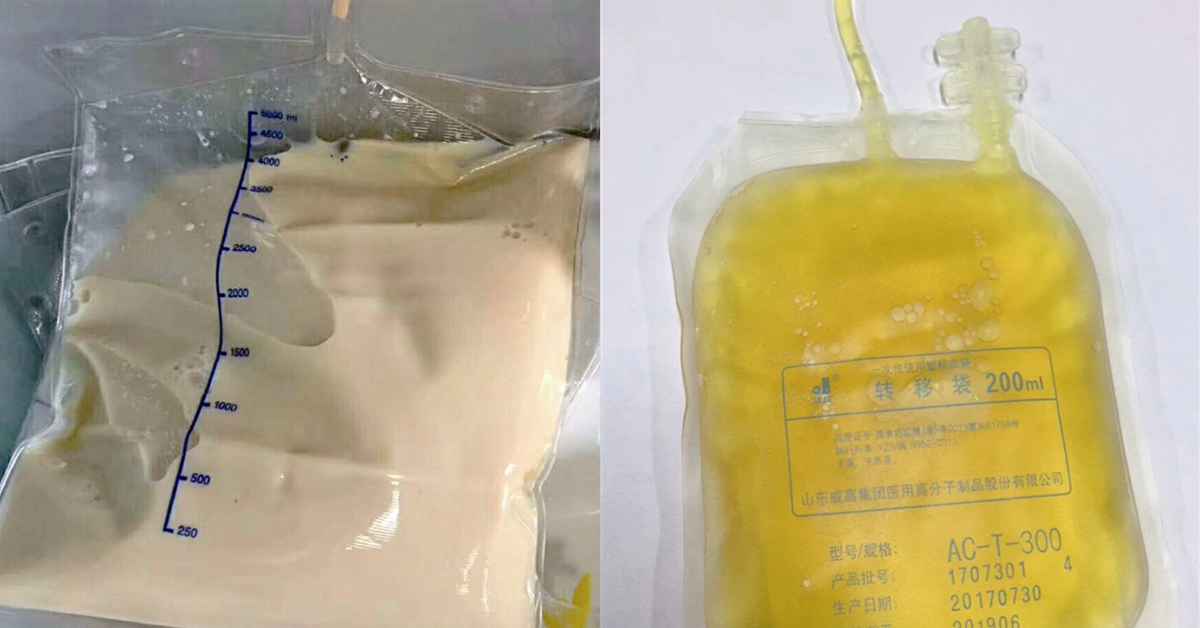 Cô gái 27 tuổi máu đục như trà sữa và "ngập dầu" vì kiểu ăn tiện lợi của nhiều người Việt trẻ