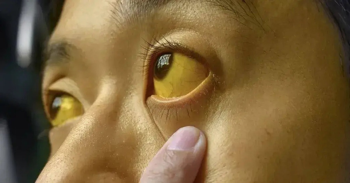 Nếu mắt có dấu hiệu bất thường, đi khám ung thư ngay