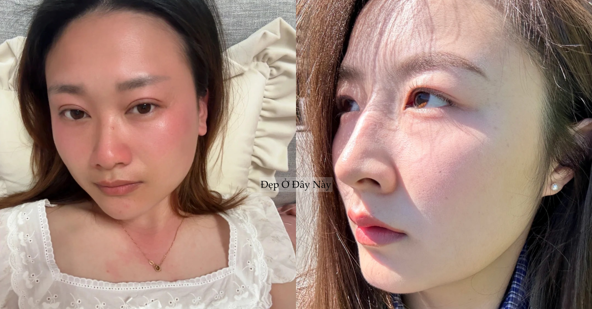 Cứu tinh" mùa hè: 4 sản phẩm làm dịu da bỏng rát, đỏ ửng sau khi đi nắng về