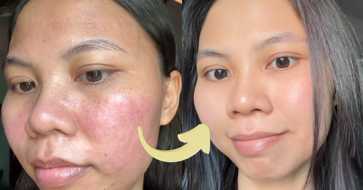 Hành trình dưỡng khí huyết "cứu" da hư tổn của cô nàng tuổi 30: Từng “toang” vì peel da, giờ da dẻ hồng hào, căng mịn, khỏe từ bên trong