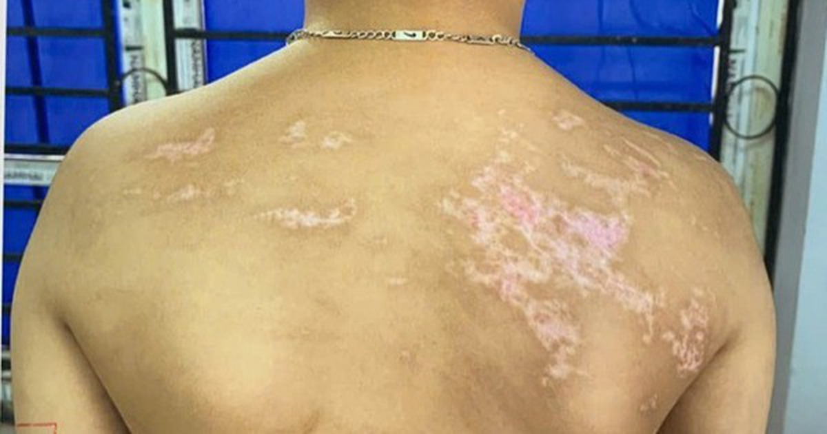 Bé trai 7 tuổi có 21 vết sẹo trên cơ thể do bị cha đẻ bạo hành