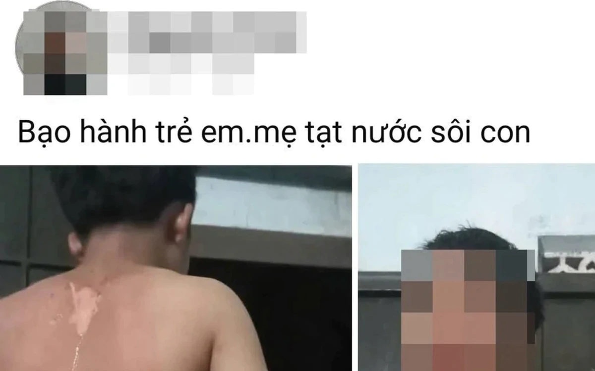 Công an vào cuộc vụ bé trai ở Đắk Lắk nghi bị mẹ tạt nước sôi