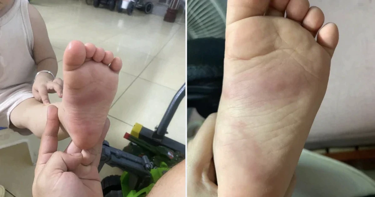 Xác minh thông tin bé trai 3 tuổi nghi bị giáo viên bạo hành ở Hưng Yên