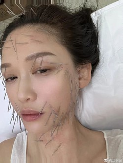 Trần Kiều Ân châm cả trăm cây kim lên mặt để làm đẹp ở tuổi 46 : "Bí thuật" trẻ hóa nhan sắc đang gây tranh cãi, "sơ hở là lệch mặt"