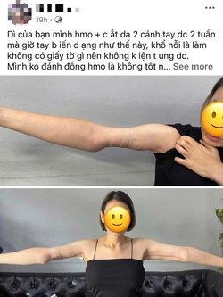 Netizen Việt sốc vì người phụ nữ có tay biến dạng sau hút mỡ, sự thật là gì?