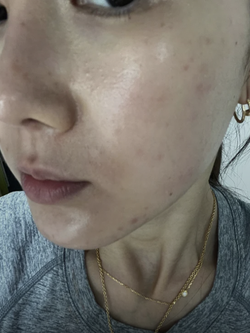 Beauty editor 29 tuổi, da tốt mà vẫn toang vì mụn: Hành trình “cứu” da chỉ với 6 sản phẩm nền tảng