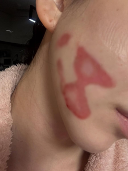 Nữ ca sĩ mất Tết, bị bỏng nặng một bên mặt khi đi làm đẹp