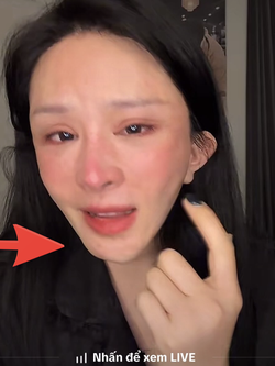 Xôn xao vụ cô gái hút mỡ hết 70 triệu nhận lại mặt biến dạng, nửa đêm "phốt" bác sĩ thẩm mỹ: Phía bác sĩ nói gì?