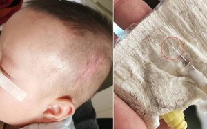 Y tá "quên" ống luồn kim trong đầu em bé, 5 năm sau nó trôi xuống cổ