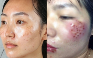 Chữa nám tại spa, người phụ nữ U40 nhận lại gương mặt "rỗ như tổ ong", dịch chảy không ngừng