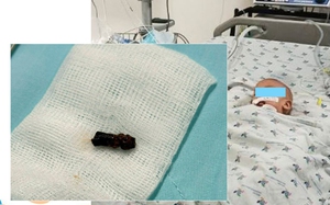 Bé trai 8 tháng tuổi chơi với trái xoài rồi đột ngột ho sặc sụa, nhập viện trong tím tái: 2 Bệnh viện phối hợp lấy dị vật