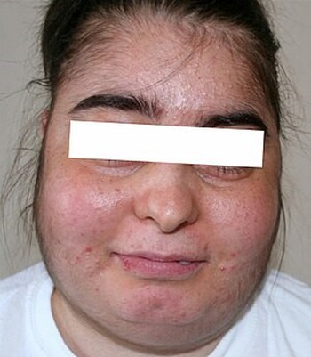 Những hiểm họa không ngờ khi sử dụng thuốc giảm đau một cách tự tiện