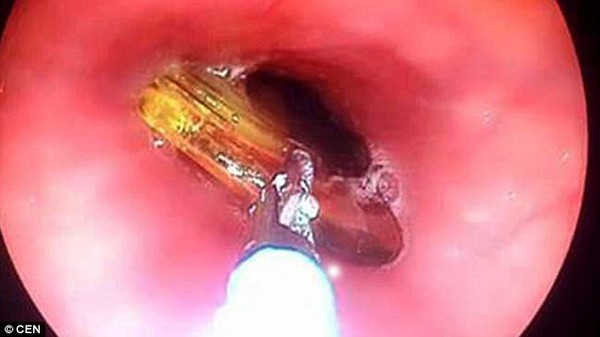 Chả hiểu sao đẩy thuốc nghẹn ở họng lại nuốt lu&ocirc;n cả lược d&agrave;i 20cm? - Ảnh 2.