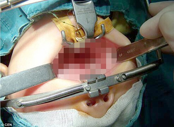 B&eacute; g&aacute;i 1 tuổi bị thủng miệng do cắn vi&ecirc;n pin cũ - Ảnh 2.