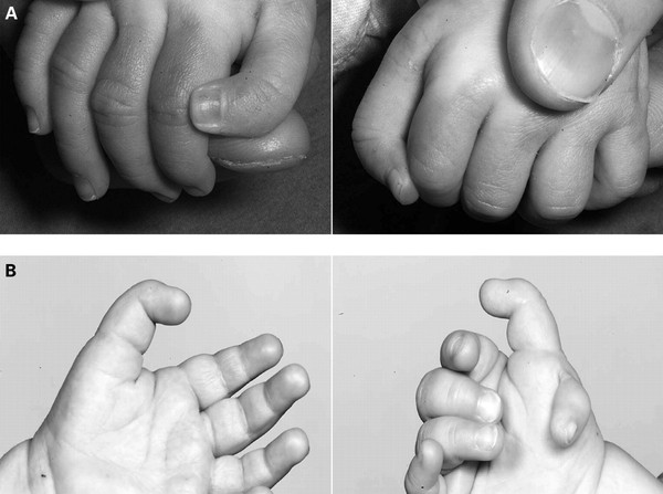 B&iacute; hiểm hội chứng b&agrave;n tay ngo&agrave;i h&agrave;nh tinh biến ng&oacute;n c&aacute;i th&agrave;nh... ng&oacute;n trỏ - Ảnh 4.