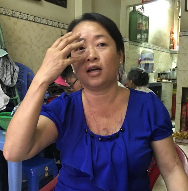 Gượng dậy sau c&uacute; tạt axit - Ảnh 2.