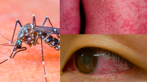 Virus ăn não người Zika có thực sự nguy hiểm? - Ảnh 2.