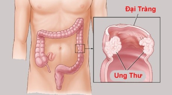 Những căn bệnh c&oacute; khả năng g&acirc;y tử vong cao nhất ở tuổi 20 - Ảnh 2.