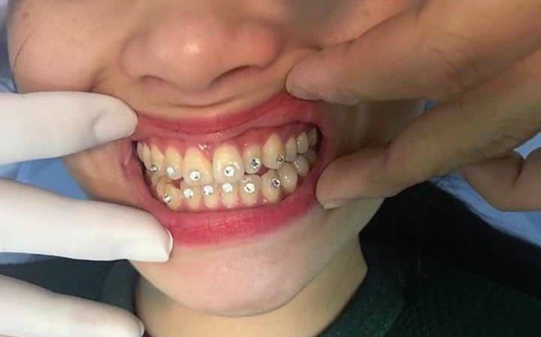 Nguyên liệu sử dụng trong quá trình đính đá răng phong thủy không gây hại cho răng miệng?
