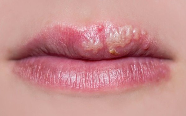 Nếu xuất hiện mảng phát ban màu đỏ quanh miệng, có nghĩa là có zona?
